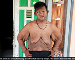 Cậu bé mập nhất thế giới giảm được 106kg