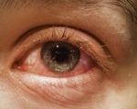 Mắt đỏ có thể là triệu chứng điển hình của COVID-19