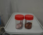 Phẫu thuật cắt túi mật 'hóa đá' và u bì buồng trứng cho một bệnh nhân