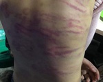 Bé gái 12 tuổi ở Hà Nội bị mẹ đẻ và người tình đánh đập dã man