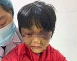 Bé gái 6 tuổi bị mẹ đẻ bạo hành thâm tím mặt