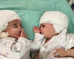 Israel tách thành công cặp song sinh dính liền đầu sau ca phẫu thuật kéo dài 12 giờ