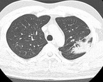 F0 bị nhẹ bất ngờ phát hiện nhiều tổn thương phổi hậu COVID-19