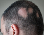 Rụng tóc và rối loạn chức năng tình dục - triệu chứng COVID-19 kéo dài mới