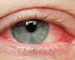 Bệnh đau mắt đỏ lây lan: Việc cần làm và việc cần tránh
