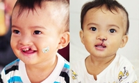 Children receive free cleft lip and palate surgery
