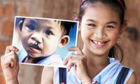 Vietnamese children receive free cleft lip and palate surgery
