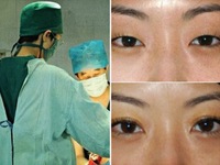 Phụ nữ Trung Quốc không ngại 'đổ' tiền cho phẫu thuật thẩm mỹ