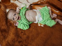 Trẻ em - Nạn nhân vô tội của nạn đói trong nội chiến Yemen