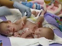 Mỹ: Phẫu thuật tách rời thành công cặp đôi song sinh 2 tuổi dính liền