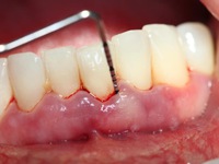 Phụ nữ mắc bệnh nướu răng có nguy cơ cao bị ung thư