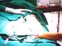 Một bệnh nhân suýt bị hoại tử chân vì “cắt lễ”