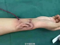 Trung Quốc: Cấy ghép thành công tai nhân tạo phát triển trên cánh tay