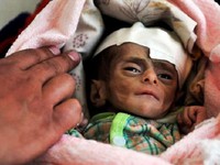 Trẻ em Yemen suy dinh dưỡng nghiêm trọng