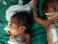 Ấn Độ: 30 bác sĩ, y tá mổ tách thành công cặp song sinh dính liền