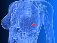 3 bệnh ung thư thường gặp ở nữ giới