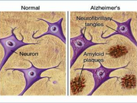 Tìm ra cách phát hiện Alzheimer trước 15 năm