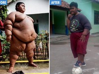 Cậu bé nặng nhất thế giới đã trút bỏ được 83 kg nhờ phẫu thuật