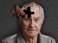Những nguyên nhân gây bệnh Alzheimer