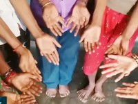 Ấn Độ: Cả gia đình 25 người đều bị tật thừa ngón
