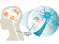 Protein trong tủy sống bệnh nhân Alzheimer cho biết giai đoạn bệnh