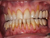 Thuốc lá điện tử có thể gây viêm nướu, các bệnh răng lợi khác