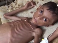 Khoảng 20 triệu người thiếu ăn, Yemen đứng bên bờ vực của nạn đói