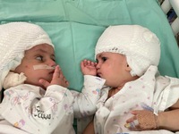 Israel tách thành công cặp song sinh dính liền đầu sau ca phẫu thuật kéo dài 12 giờ
