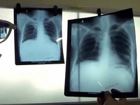 Bệnh lao phổi - đại dịch mới tại Ấn Độ sau COVID-19