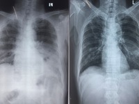 Hậu COVID-19: Bệnh nhân bị áp xe phổi, tràn khí màng phổi