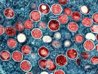 Dạng đậu mùa khỉ 'khủng khiếp' ảnh hưởng đến người nhiễm HIV giai đoạn cuối