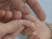 Trẻ mắc tay chân miệng gia tăng tại Bệnh viện Nhi đồng Cần Thơ