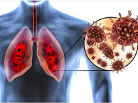 Phát hiện nguyên nhân tổn thương phổi do COVID-19