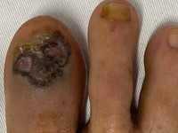 Mắc ung thư tế bào hắc tố sau khi xuất hiện mảng đen ở ngón chân