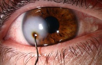 Suýt mù mắt vì mảnh kim loại đâm thủng mắt
