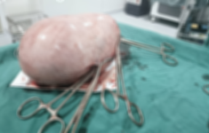 Cắt bỏ khối u xơ tử cung choán hết ổ bụng bệnh nhân