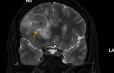Đau nhức âm ỉ vùng trán, bất ngờ phát hiện khối u não nguy hiểm
