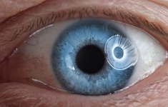 Phẫu thuật võng mạc dịch kính - giải pháp giảm nguy cơ mù loà