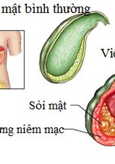 Chớ xem thường triệu chứng viêm túi mật