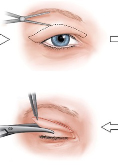 Phẫu thuật tạo hình mí mắt không hề đơn giản