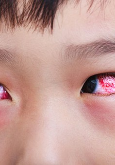 Bệnh đau mắt đỏ và cách phòng trị