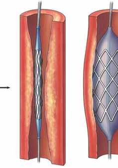 Giải pháp mới cho bệnh nhân mạch vành