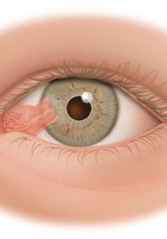 Bệnh mộng mắt và phương pháp điều trị