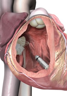 Mỹ: Cấy ghép máy tạo nhịp tim nhỏ nhất thế giới