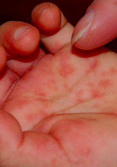 Bình Định xuất hiện nhiều ca sốt xuất huyết và tay chân miệng mới