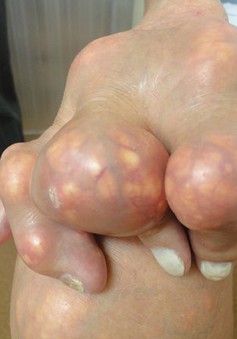 "Cục tophi” - Người mắc bệnh gout cần cẩn trọng với nguy cơ hoại tử