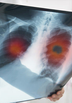 Biểu hiện của ung thư phổi thường bị bỏ qua