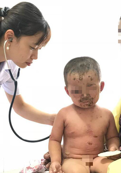 Bé trai 2 tuổi bị viêm da mủ toàn thân, loét hết mặt vì tắm nước lá