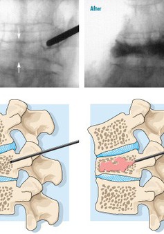 Phẫu thuật cột sống không phải là phương pháp hữu hiệu để giảm đau lưng do loãng xương