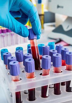 Xét nghiệm máu mới có thể phát hiện 10 bệnh ung thư